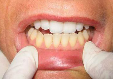 Дисколорит зубов