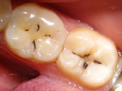 Герметизация фиссур зубов