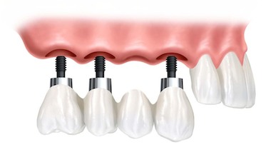 Инновационные методы протезирования зубов