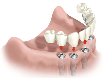 Имплантация зубов в рассрочку