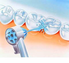 Профессиональная чистка зубов методом Air Flow