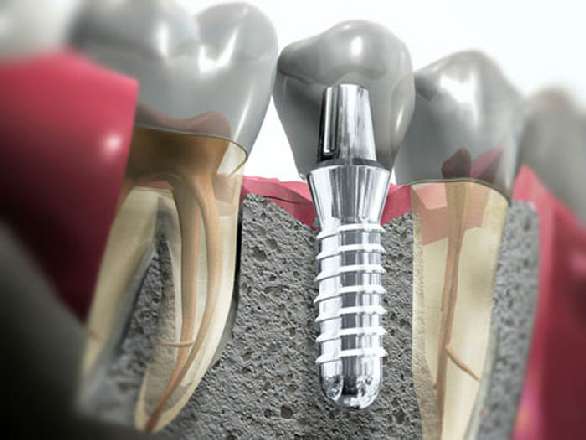 Установка дентального имплантата на место отсутствующего зуба