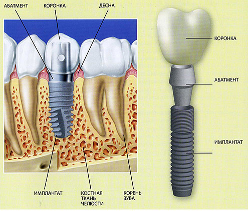 Установка импланта зубов в клинике 