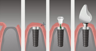 Как проводится операция по зубной имплантации?