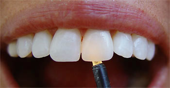 Оксид циркония – белое золото в протезировании зубов