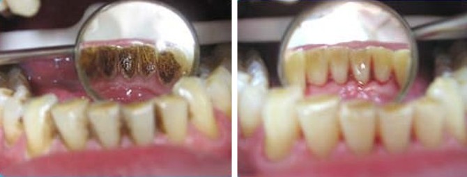 Удаление зубного камня и зубного налета