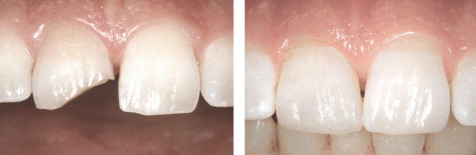 Восстановление эмали зубов, дефектов зубной эмали, коронки зуба